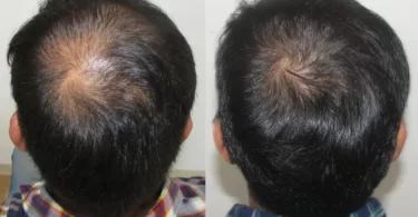 Before and after 6 months crown 640w