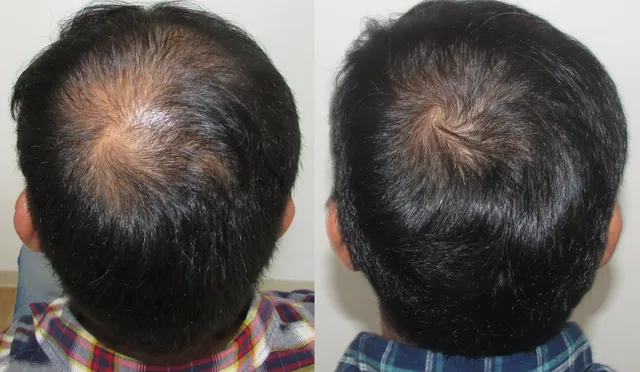 Before and after 6 months crown 640w
