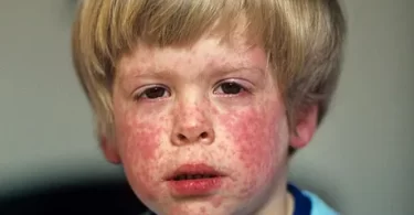 measles rash on face of i 010