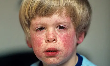 measles rash on face of i 010