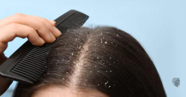 scalp fungus in women