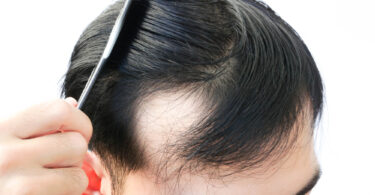 young man hair loss