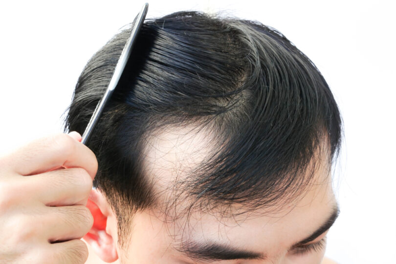 young man hair loss