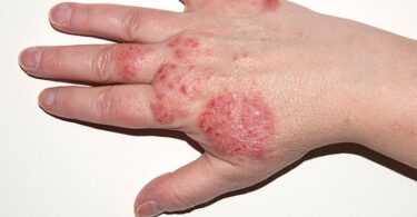 what is eczema 02 hand eczema 722x406 1