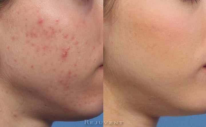 acne results side1 1